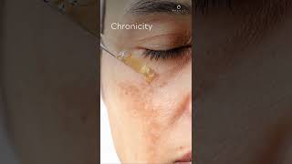 How does melasma differ from other skin pigmentation disorders  Ensoul Medical Clinic [upl. by Artekal]