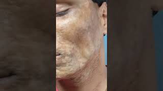 Morphea  Scleroderma  एक साधारण बीमारी भी इलाज के अभाव में काफी ख़तरनाक रूप ले सकती है  morphea [upl. by Repard]