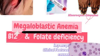 Megaloblastic AnemiasB12 deficiency and Folate Deficiency anemia usmlepreparation b12deficiency [upl. by Onaivlis]