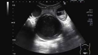 Ultrasound Video showing Haematometrium with Hydrosalpinx [upl. by Recha583]