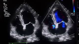 APICAL HYPERTROPHIC CARDIOMYOPATHYApical HCM heart hypertrophy [upl. by Beitnes655]