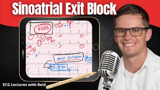 Sinoatrial SA Exit Block EKG  ECG Lecture [upl. by Nerb566]