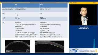 Hypertonie et uvéites  cas clinique Florent Aptel [upl. by Sylirama203]