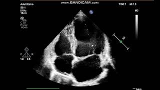 Mitral valve prolapse Severe Mitral regurgitation echocardiography [upl. by Rexfourd]