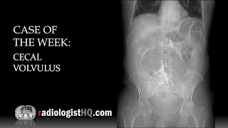 Case of the Week Cecal Volvulus Xray amp CT [upl. by Alaaj]