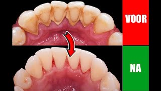 Zo verwijder je tandplak van je tanden zonder naar de tandarts te gaan [upl. by Battiste]