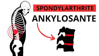 Spondylarthrite Ankylosante  Symptômes Causes Traitement [upl. by Ettegroeg]