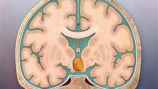 Transcallosal TC Surgical Approach to Hypothalamic Hamartomas [upl. by Ettelrac]