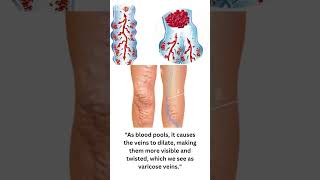 quotUnderstanding Varicose Veins Why Do Veins Dilatequot [upl. by Aynotahs]