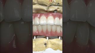 Fabulous Full Mouth Zirconia Arches lsk121shorts dentist [upl. by Quincey928]