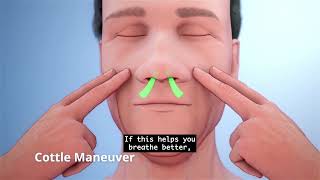 If you suffer from Nasal Obstruction the VivAer procedure may be able to help [upl. by Aserat]