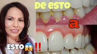 limpieza dental profunda en Estados Unidosperiodontitis [upl. by Sephira]