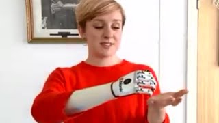 bionic hand UK user receives ‘world’s most lifelike’ bionic hand [upl. by Czarra799]