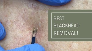 Best Blackhead Removal  Dr Derm [upl. by Mcnamee239]