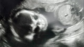 Mom Freaked Out by Skeletal Ultrasound Photo [upl. by Philemon]