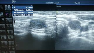 une belle adenopathie metastatique dun carcinome papillaire réséqué [upl. by Roma842]