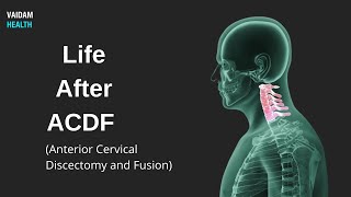 Life After ACDF Anterior Cervical Discectomy and Fusion [upl. by Evette]