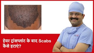 How To Remove Scabs After Hair Transplant हेयर ट्रांसप्लांट के बाद scabs कैसे हटाएं  HairMD Pune [upl. by Rhodie710]