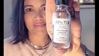 20 TCA FACIAL PEEL  STEP BY STEP TUTORIAL [upl. by Carlen463]