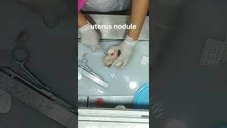 uterus nodule grossing [upl. by Auoh244]