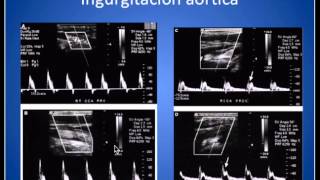 Analisis Onda Espectral Arterias Carótidas y Vertebrales [upl. by Rennane391]