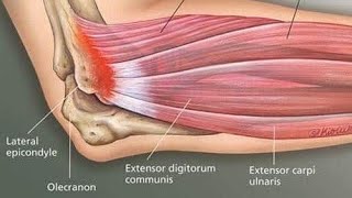 Lateral Epicondylitis tennis elbow exercise [upl. by Aehsa]