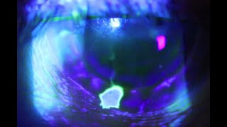 A positive Seidels Test or the corneal waterfall sign [upl. by Ahtelahs]