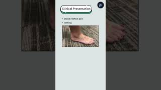 Bifurcate Ligament Injuries youtube youtubeshorts bifurcateligamentinjury [upl. by Anawik407]