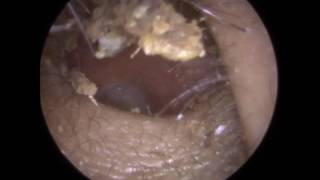 206 Ear Wax CRUMBLE Removed using Ear Hook and Jobson Horne  Mr Neel Raithatha THC [upl. by Quinby]