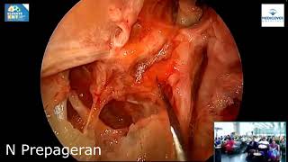 Module 5 Endoscopic Vidian Canal Meckels Cave and Lateral Sphenoid Recess Exposure of Skull Base [upl. by Azilef]