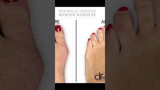 Revolutionary Bunion Surgery A GameChanger for Foot Pain Relief [upl. by Hake]