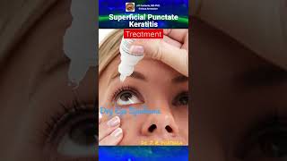 Superficial Punctate Keratitis Treatment [upl. by Wolk]