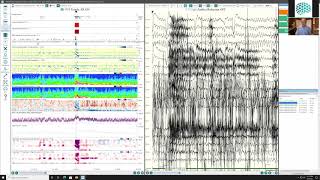 Using Persyst 14 in the EMU with Dr Mark Scheuer [upl. by Melinde]