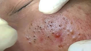 Big Cystic Acne Blackheads Extraction Blackheads amp Milia Whiteheads Removal Pimple Popping  9199 [upl. by Ailsun]