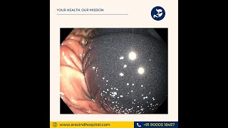 orbera Intra gastric balloon placement [upl. by Nosreg]