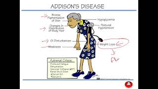 Adult Health Nursing 2 Addison’s Disease Adrenocortical Insufficiency Cushing Syndrome [upl. by Anesusa]