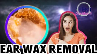 AnikaENT EAR WAX REMOVAL  What Signs And Symptoms Are Related To Excessiv Ep52 [upl. by Hcirdeirf100]