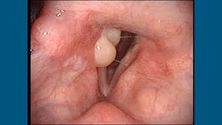 Post Intubation Arytenoid Granuloma [upl. by Frederik]