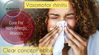 Vasomotor rhinitis  Other Non allergic rhinitis [upl. by Ursula]