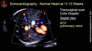 Fetal echocardiography at 1113 weeks Early Fetal Echo 31 clips of Normal Hearts [upl. by Jovitah]