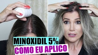 COMO APLICAR MINOXIDIL  NÃO RESSECA O CABELO [upl. by Assenar]