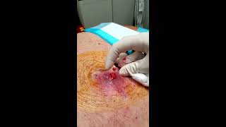 HD Graphic Step by Step Abscess and Infected Lipoma Drainage Medical Education amp Training [upl. by Enybor]