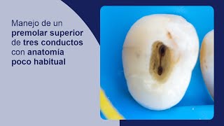 Manejo de un premolar superior de tres conductos con anatomía poco habitual [upl. by Albemarle]