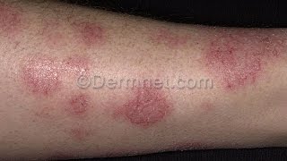 Varicose Eczema  7 Facts About Varicose Eczema You Must Know [upl. by Ecnerual]