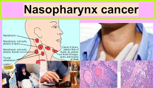 nasopharynx cancer [upl. by Arata111]