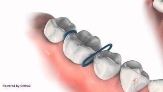 Orthodontic Spacers [upl. by Victorine]