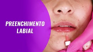 Aula de Preenchimento Labial [upl. by Atena384]