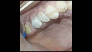 Visit your local prosthodontist for more advice on permanent tooth replacement [upl. by Audry]