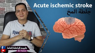 جلطة المخ  Acute ischemic stroke [upl. by Hewet]