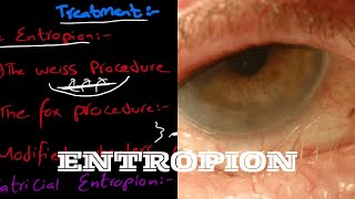 What is Entropion  And it’s types  signs and symptoms  and treatment explained in very easy words [upl. by Ynots528]